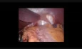 Single-Site Laparoscopic Adjustable Gastric Banding - Initial Experience