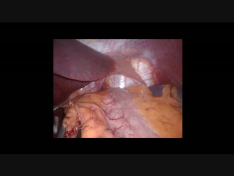 Single-Site Laparoscopic Adjustable Gastric Banding - Initial Experience