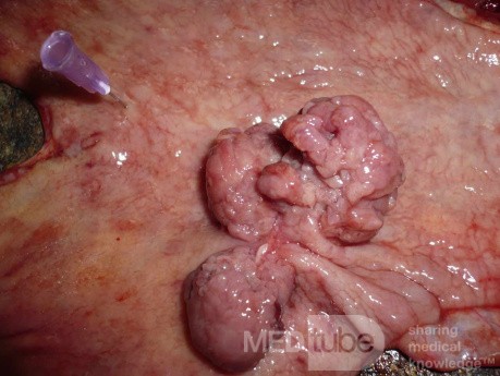 Polypoid Adenocarcinoma (8 of 9)