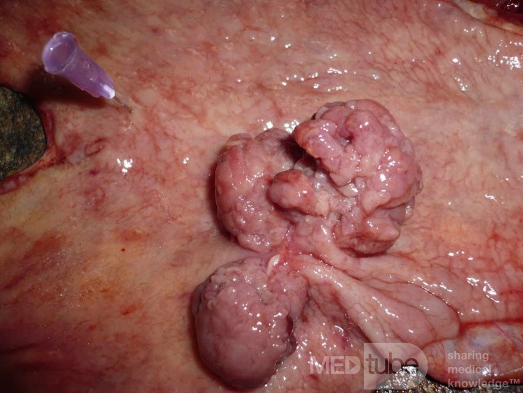 Polypoid Adenocarcinoma (8 of 9)