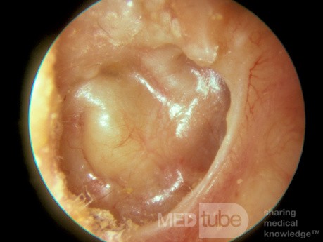 Severe Atelectasis