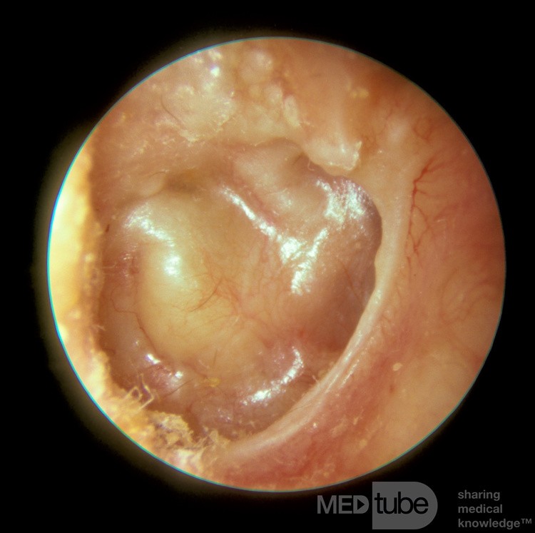 Severe Atelectasis
