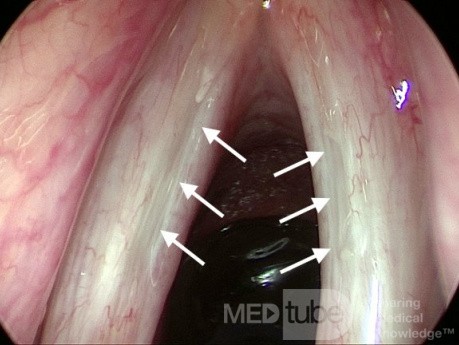 Bilateral Sulcus Vocalis