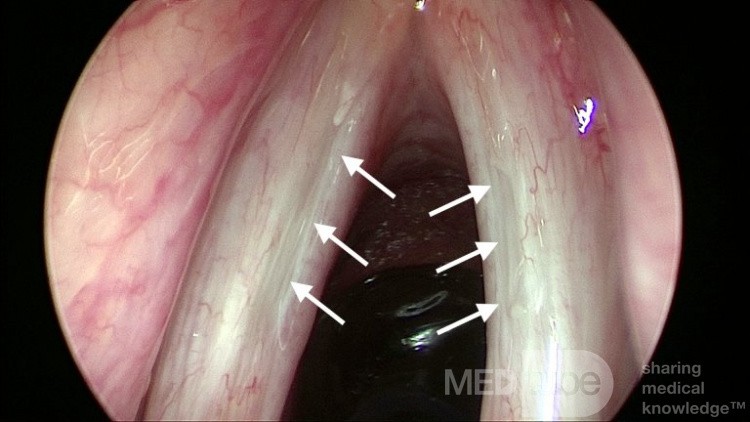 Bilateral Sulcus Vocalis
