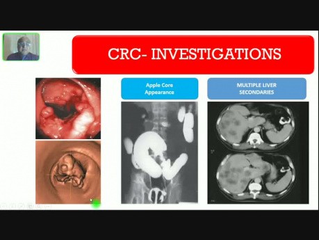 Colorectal Carcinoma - Lower GI Hemorrhage