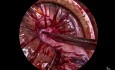 Vaginal Morcellation for Large Fibroid Uterus