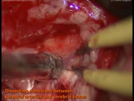 MCA Aneurysm - Right Pterional Approach