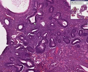Endometrium - Hyperplasia