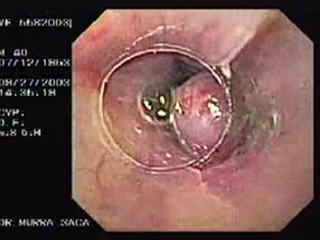 Acute Variceal Bleeding - View through the Special Cylinder