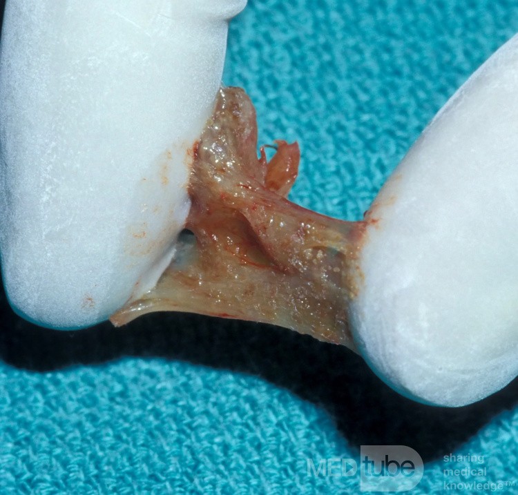 Allergic Fungal Sinusitis [contents of maxillary sinus]