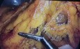 Laparoscopic cephalic duodenopancreatectomy (Whipple)