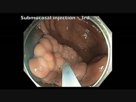 Ileocecal valve injection