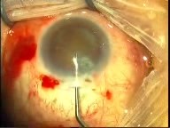Manual Phaco In Trachoma