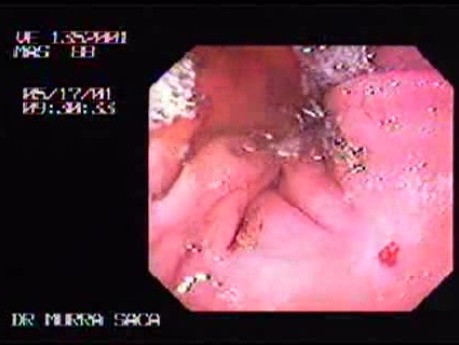 Ulcer Scar of the Gastric Corpus