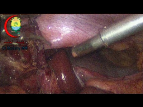Stone Impacted in Hartman's Pouch