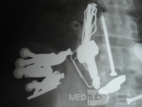 Multiple Foreign bodies in the GI tract (7 of 12)