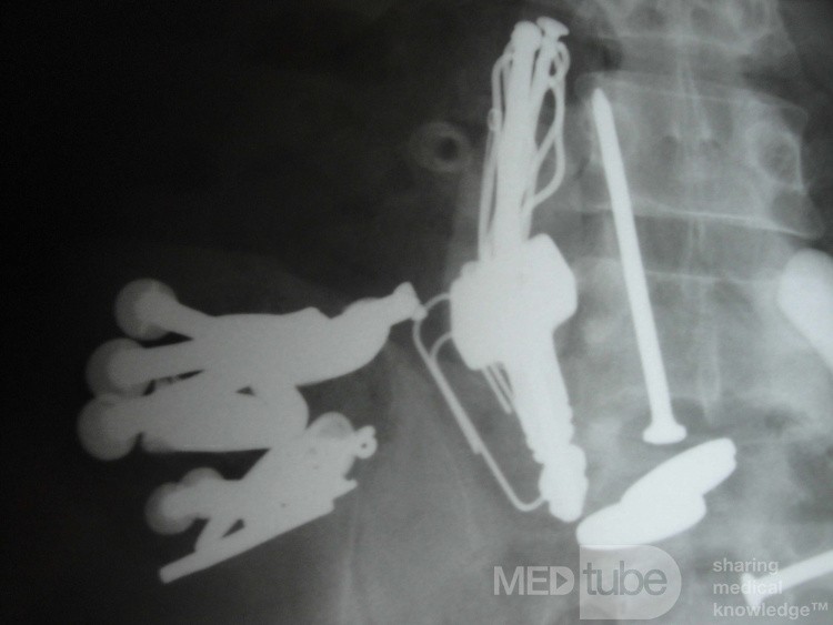 Multiple Foreign bodies in the GI tract (7 of 12)