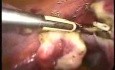 Hysterectomy With Two Operativ Trocarts