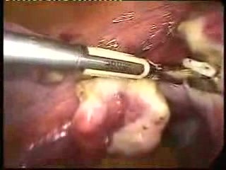 Hysterectomy With Two Operativ Trocarts