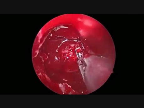 Removal of Pituitary Tumour via the Nose  - Endoscopic Hypophysectomy