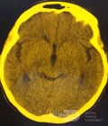 Endoscopic Third Ventriculostomy in a Benign Case of Aicardi Syndrome with Obstructive Hydrocephalus and Chiari Malformation type 1