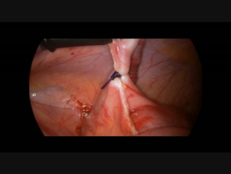 Laparoscopic Reduction of Intussusception in 5 Year Old Boy