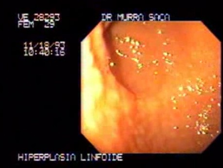Follicular Lymphoid Hyperplasia