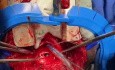 Tracheo Esophageal Fistula Repair 