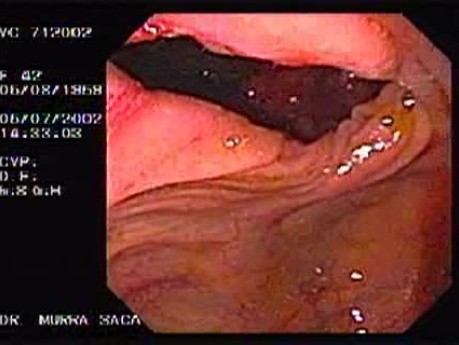 Crohn's Disease - Endoscopy (22 of 28)