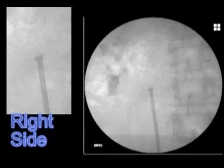 Ureteric Stent Deployment