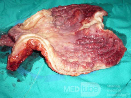 Endoscopy of Scirrhous Gastric Carcinoma involving the entire Fundus, Body and the Antrum (35 of 47)