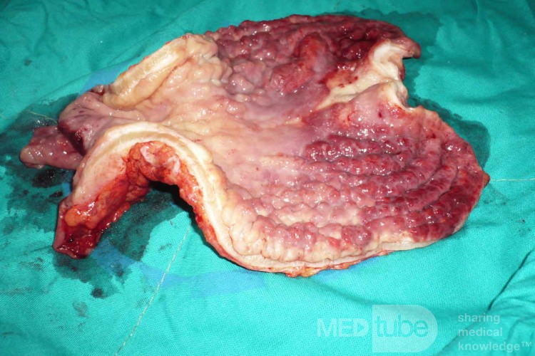 Endoscopy of Scirrhous Gastric Carcinoma involving the entire Fundus, Body and the Antrum (35 of 47)