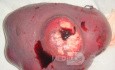 Non-Hodgkin's lymphoma of the spleen