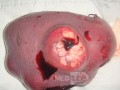 Non-Hodgkin's lymphoma of the spleen