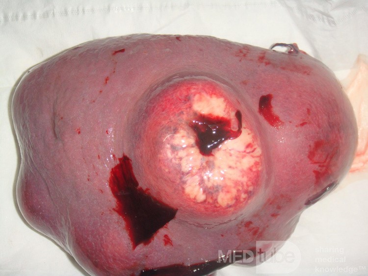 Non-Hodgkin's lymphoma of the spleen
