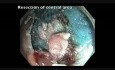 Endoscopic Mucosal Resection Of A Large Flat Lesion In Cecum