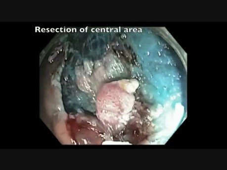 Endoscopic Mucosal Resection Of A Large Flat Lesion In Cecum
