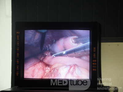 Gastric Ulcerated Adenocarcinoma of the Pre-pyloric Antrum (14 of 28)