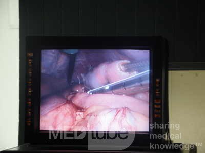 Gastric Ulcerated Adenocarcinoma of the Pre-pyloric Antrum (14 of 28)