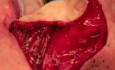 Pharyngoesophageal Reconstruction