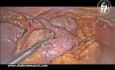 Acute Gangrenous Appendicitis