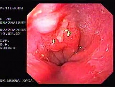 Barrett's Ulcer (1 of 5 )