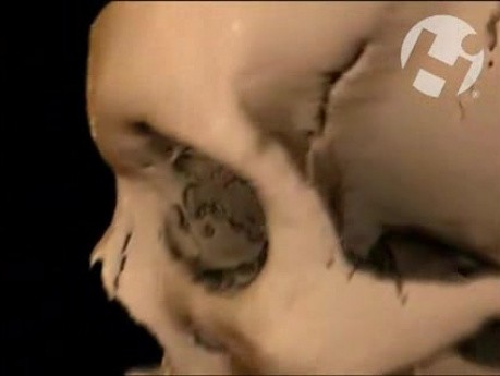 Skull and Facial Fractures