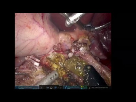 SSAT 2023 - Robotic Pancreaticoduodenectomy for Chronic Pancreatitis with MPD Stone Extraction