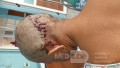 Epicranial Lesion Completely Resected Without Complications