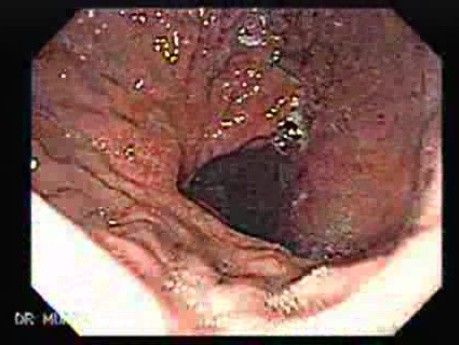 Hourglass Stomach - 67 Years-Old Woman