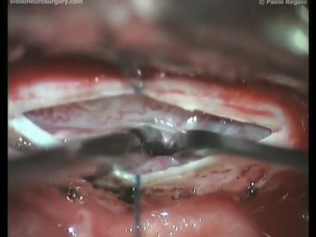 Thoracic dural AVM - Posterior Approach