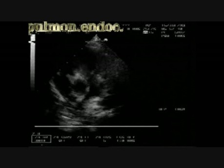 Infective Endocarditis: Vegetation On The Pulmonic Valve