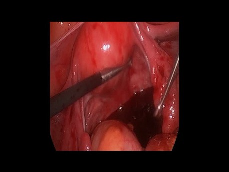 Hemoperitoneum Ectopic Gestation Laparoscopy