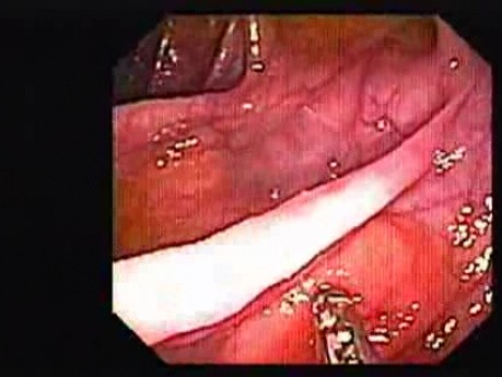 Colonic Lipoma (4 of 4)